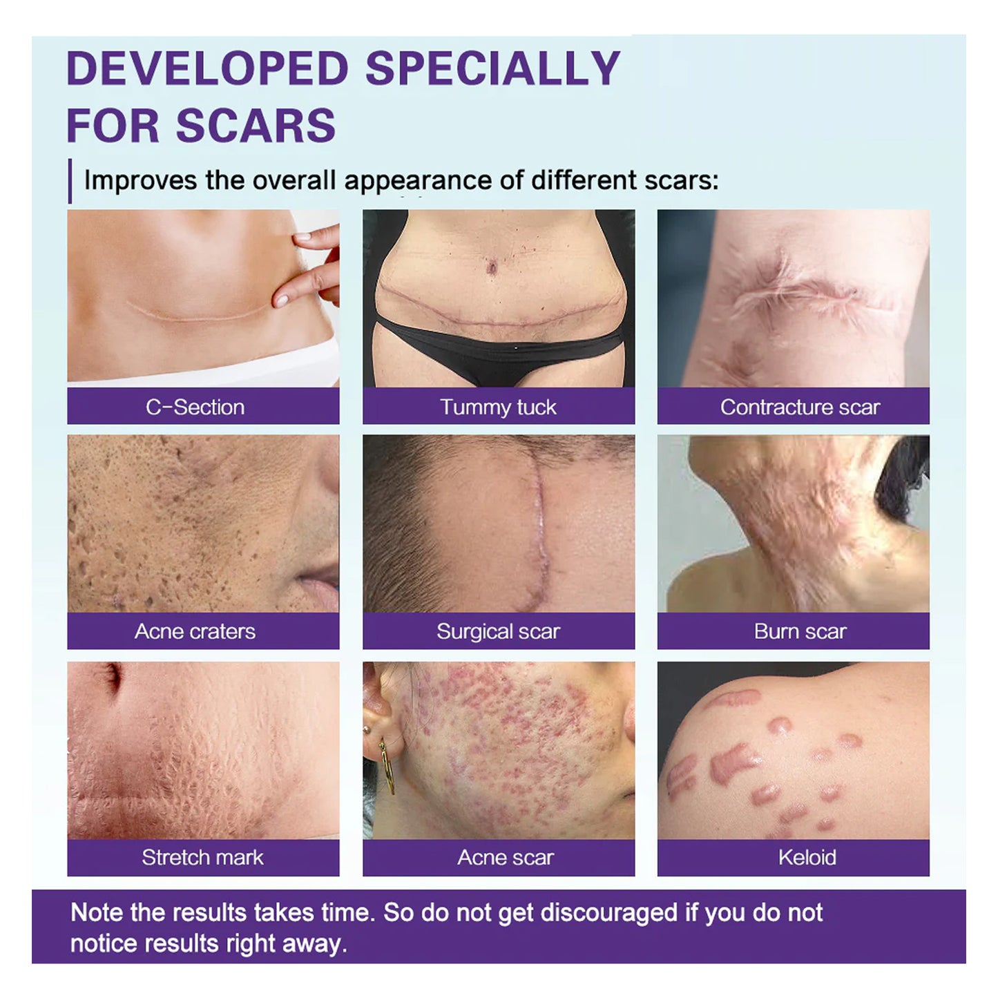 High-quality Silicone Scar Gel, Lighten Acne Mark Scar Repair Skin Smoothing Care Cream
