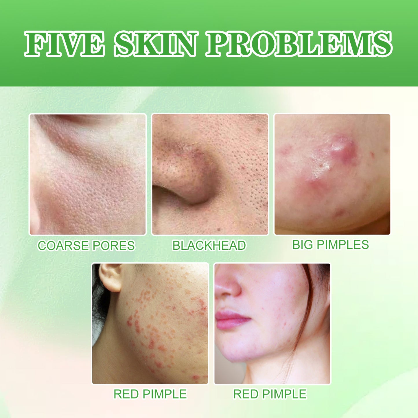 Salicylic Acid Cleaning Gasket, Moisturizing Oil Control Removing Blackheads And Acne Closing Gentle Cleansing Acne Muscle Repair