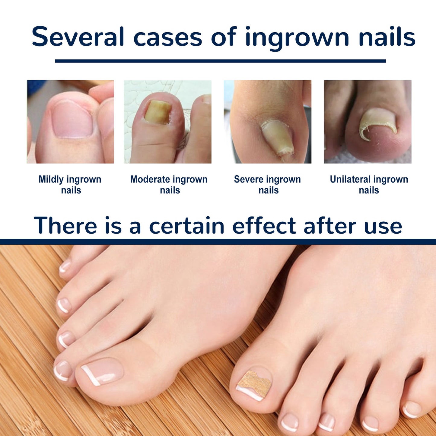 EELHOE Nail Correction Patch, Nail Insert Correction And Repair Toe Manicure Nail Patch