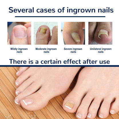 EELHOE Nail Correction Patch, Nail Insert Correction And Repair Toe Manicure Nail Patch