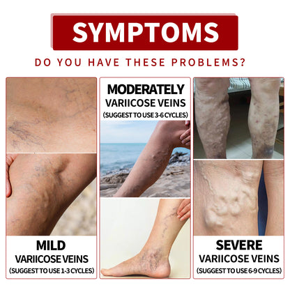 Venous Massage Varicose Cream, Relieves Bulging Leg Blood Vessels And Swollen Leg Earthworm Venous Massage Cream